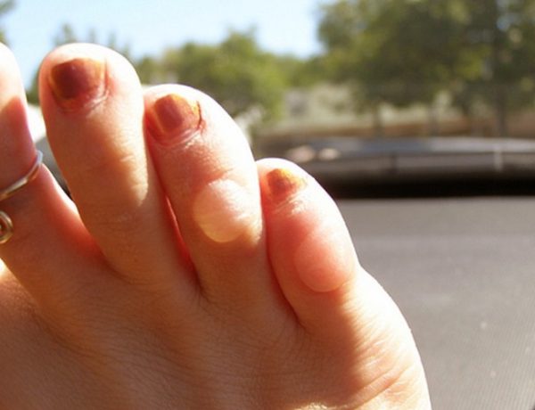 лечение мозолей на пальцах ног